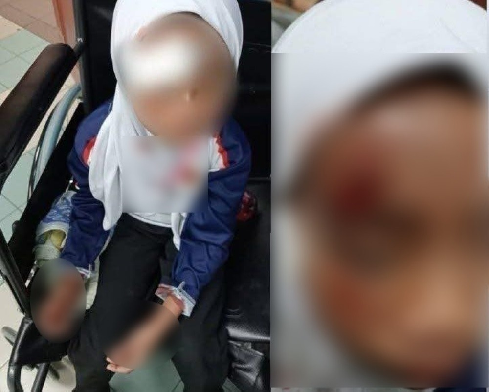 Melaka Girl Badly Hurt in Hit-and-Run Near Bukit Katil School 2 Melaka Girl Badly Hurt in Hit-and-Run Near Bukit Katil School