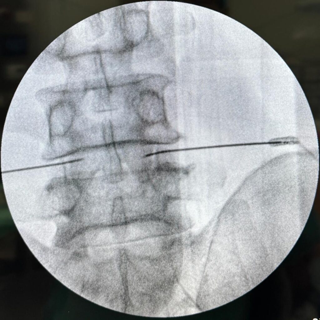 Why Interventional Pain Management is Key for Chronic Pain Relief