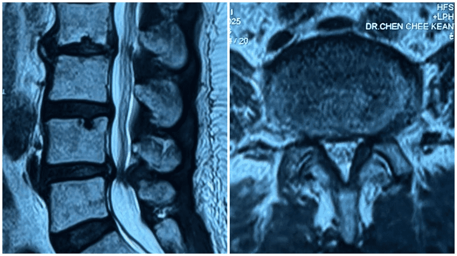 Why Interventional Pain Management is Key for Chronic Pain Relief