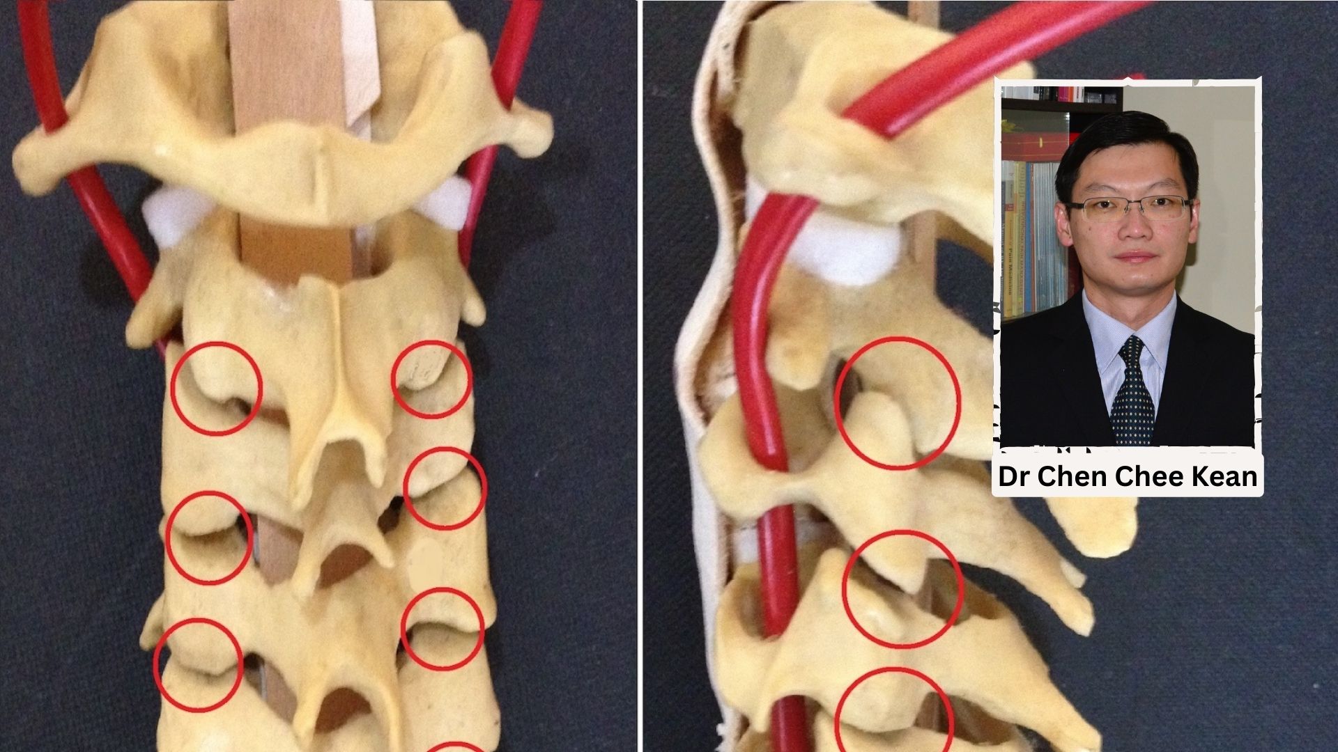 Cervical Facet Joint Pain A Growing Health Concern Among Malaysians