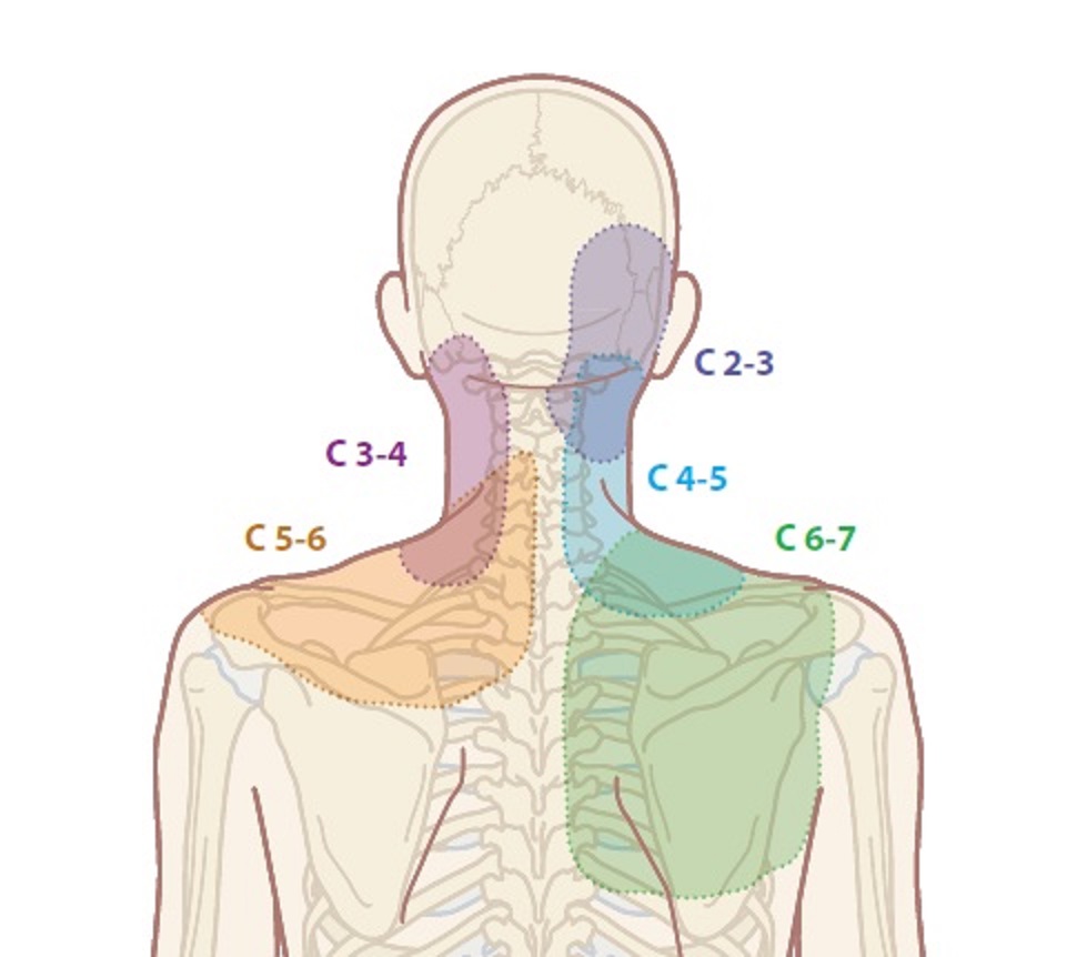 Cervical Facet Joint Pain: A Growing Health Concern Among Malaysians 4 Cervical Facet Joint Pain: A Growing Health Concern Among Malaysians