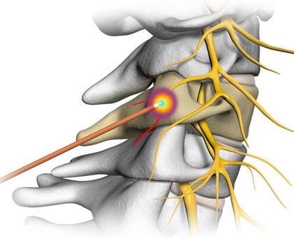 Cervical Facet Joint Pain: A Growing Health Concern Among Malaysians 3 Cervical Facet Joint Pain: A Growing Health Concern Among Malaysians
