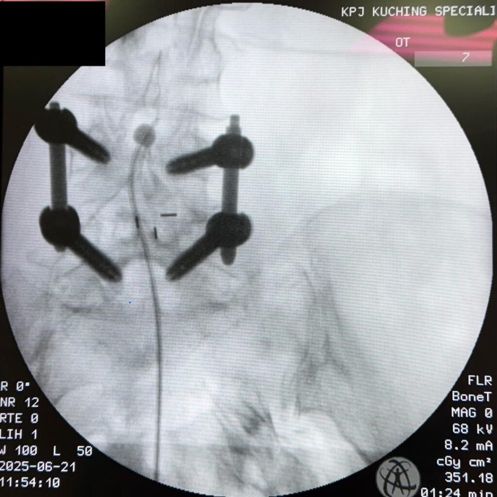 Breakthrough Spine Treatment Now Available at KPJ Kuching