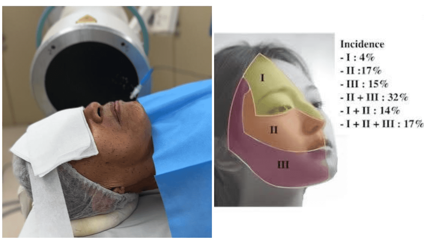 Understanding Trigeminal Neuralgia Dr Chen Chee Kean Explains the ‘Electric Shock’ Face Pain