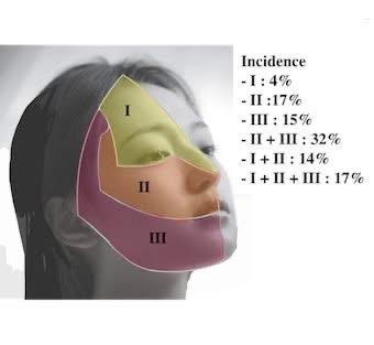 Understanding Trigeminal Neuralgia Dr Chen Chee Kean Explains the ‘Electric Shock’ Face Pain